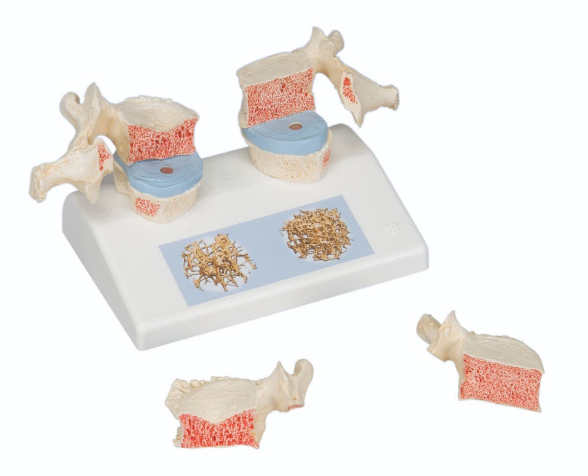 Anatomicalmodel:osteoporosismodel