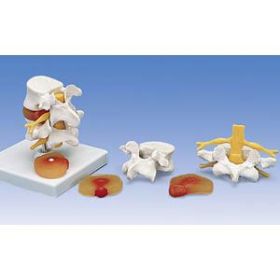 Lumbar Spinal Column W/Prolapsed Intevertebral Dsc