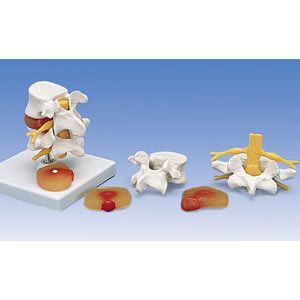 Lumbar Spinal Column W/Prolapsed Intevertebral Dsc