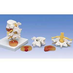 LumbarSpinalColumnW/ProlapsedIntevertebralDsc